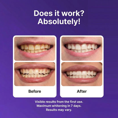 Opelle™ PAP+ Purple Whitening Strips